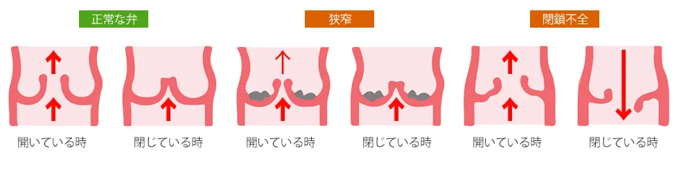 心臓弁膜症は２種類あります