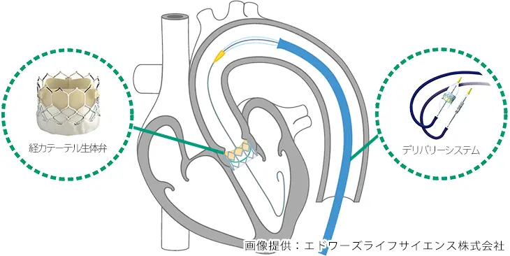 経カテーテル的大動脈弁植え込み術「TAVI」